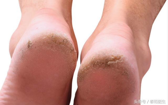 脚底死皮一撕一大块,脚底死皮撕到肉了