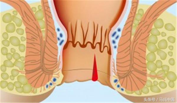 肛裂的病因病机不包括,肛裂中医原因