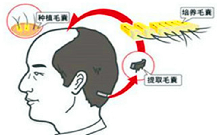种头发靠谱吗真的有用吗,种头发的好处