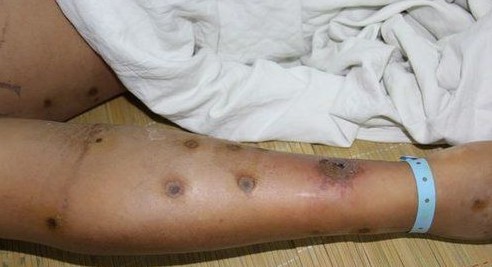 野外毒蜂蜇伤怎么处理,女子被蜂蛰被警察送医