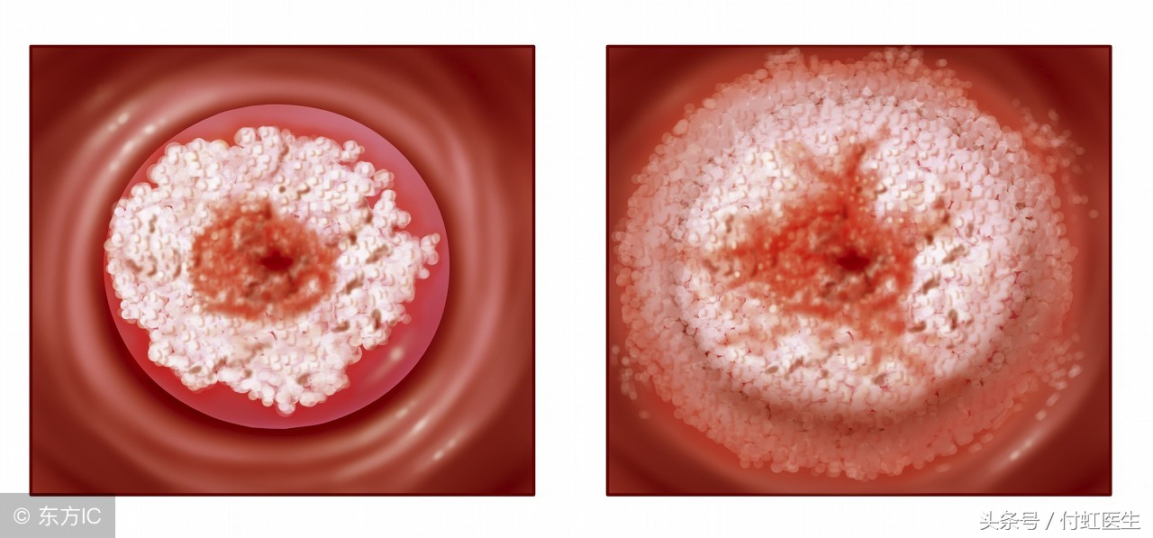 hpv18阳性tct低度病变是宫颈癌吗,hpv18阳性tct高度病变是宫颈癌吗