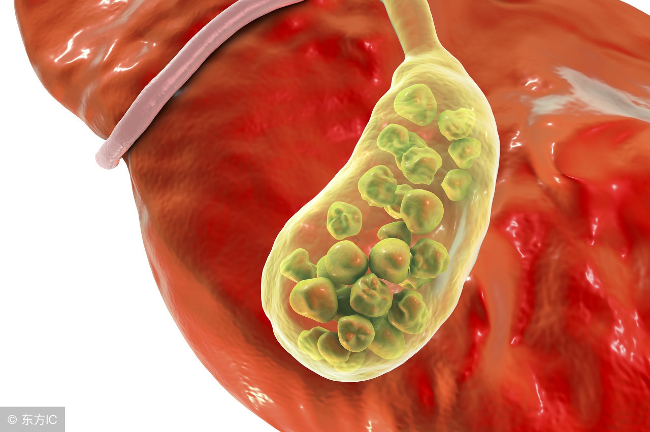 肝内胆管结石严重吗?治疗方面有什么对策