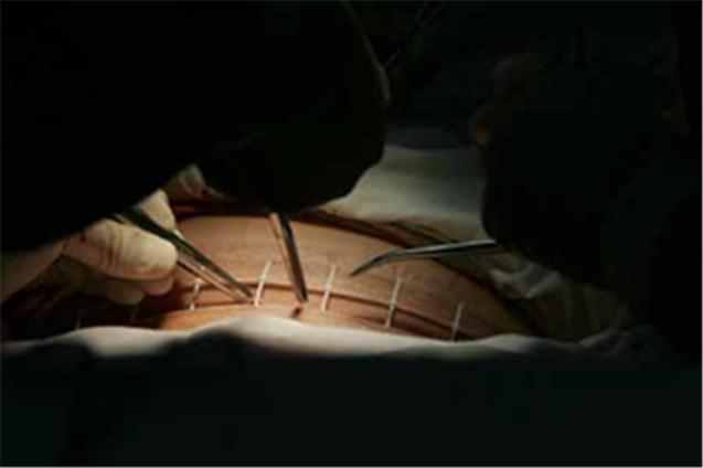 剖腹产第18天伤口裂开，产妇再次被送进医院，医生对老公发飙