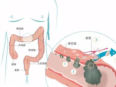 90岁老人结肠癌有没有必要手术,90岁老人结肠癌可以手术吗