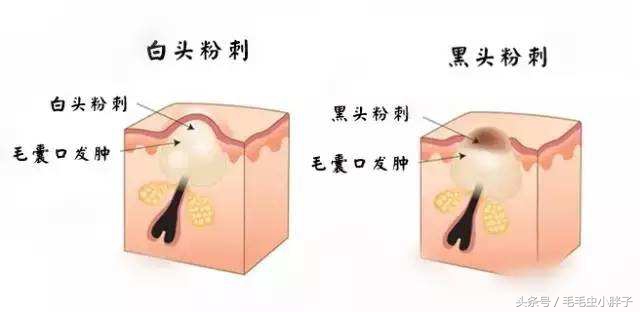 痘痘肌的处理及应对方法,痘痘大作战有没有秘籍