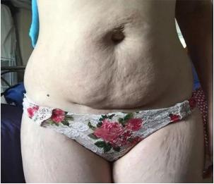 孕妇油预防妊娠纹,孕妇怎样预防妊娠纹抹什么