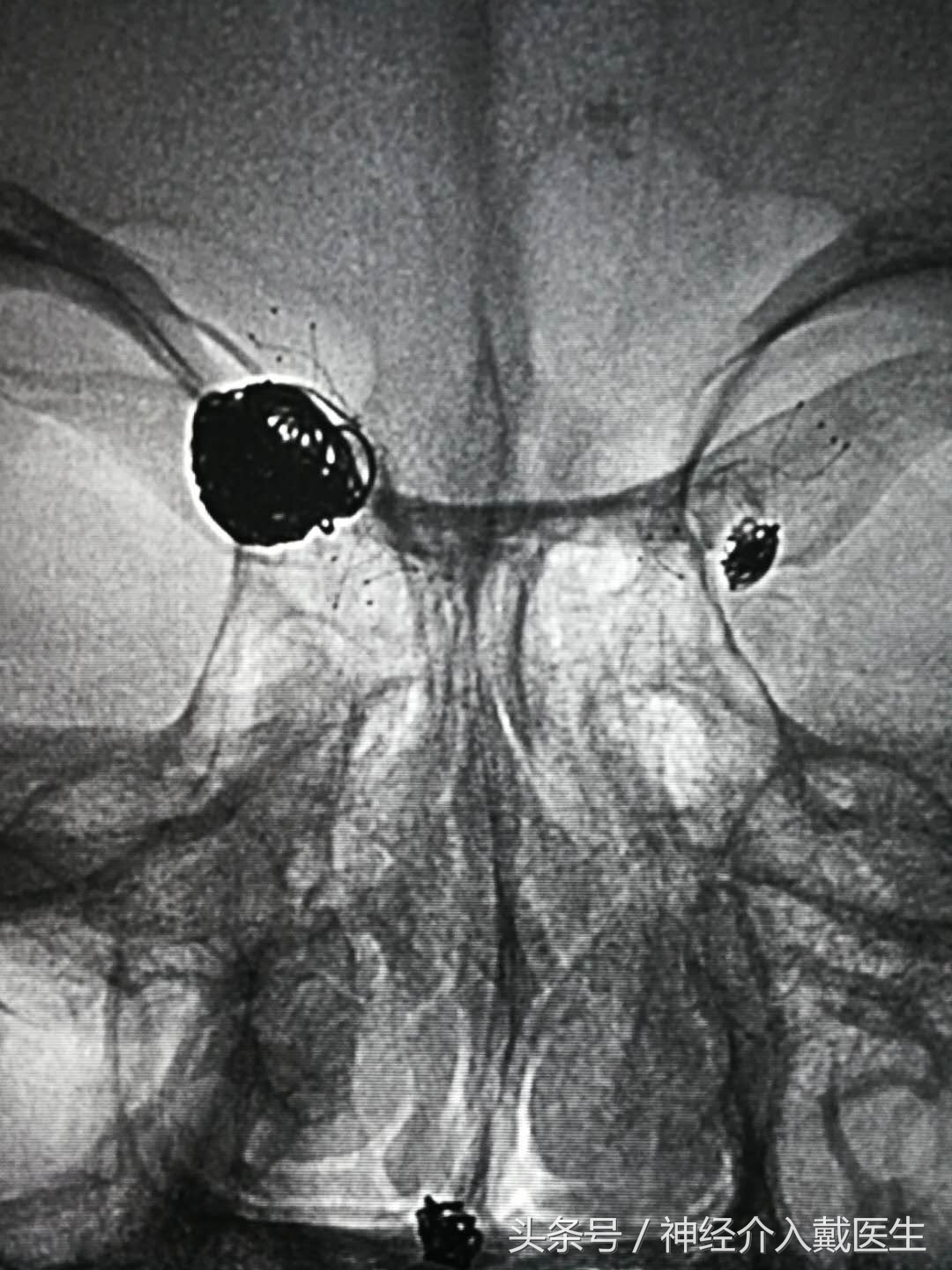 脑血管畸形介入手术是放支架吗,脑部血管支架介入手术风险大吗