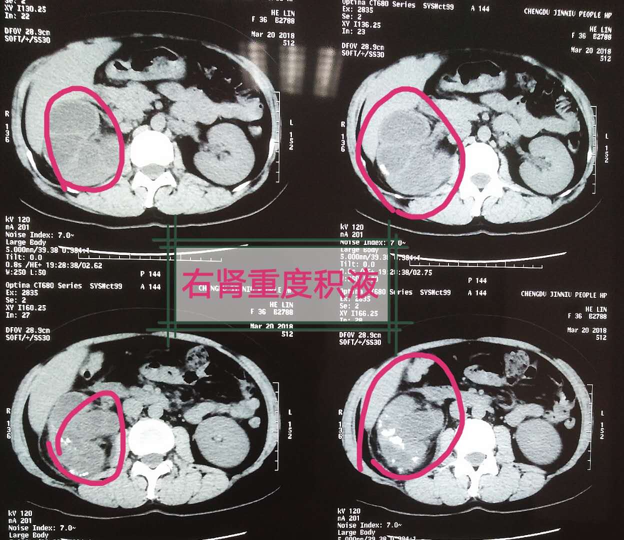 巨大肾结石的标准,巨大肾结石怎么治最好