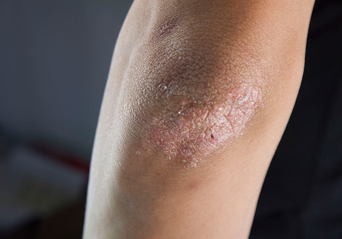 中医治疗湿疹是让湿疹发出来吗,春天湿疹用哪个中成药