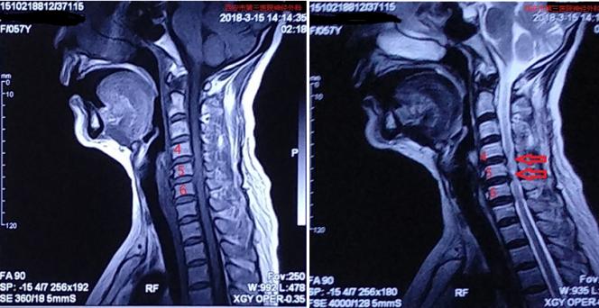 神经根型颈椎病大夫让按摩推拿,祖传神经根型颈椎病正骨复位手法
