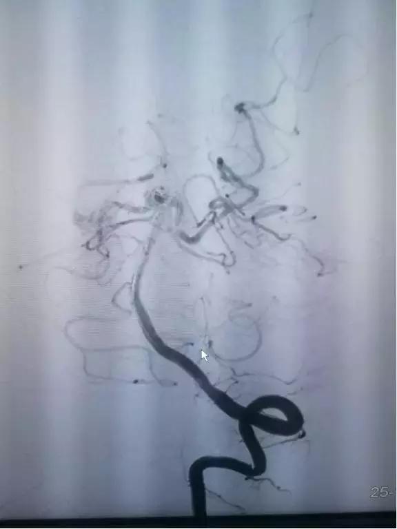 介入栓塞动脉瘤,颅内动脉瘤介入栓塞术全过程