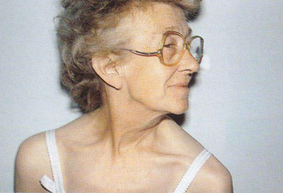 歪脖治疗,歪脖病是什么原因引起的