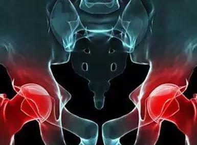 股骨头坏死病因及危险因素,股骨头容易坏死的部位