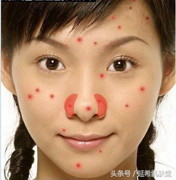 下巴长满痘痘是什么原因怎么调理,下巴不停冒脓包型痘痘怎么样调理