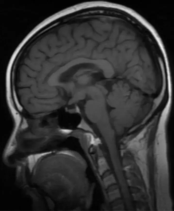复旦大学附属中山医院放射科病例讨论（八十四）