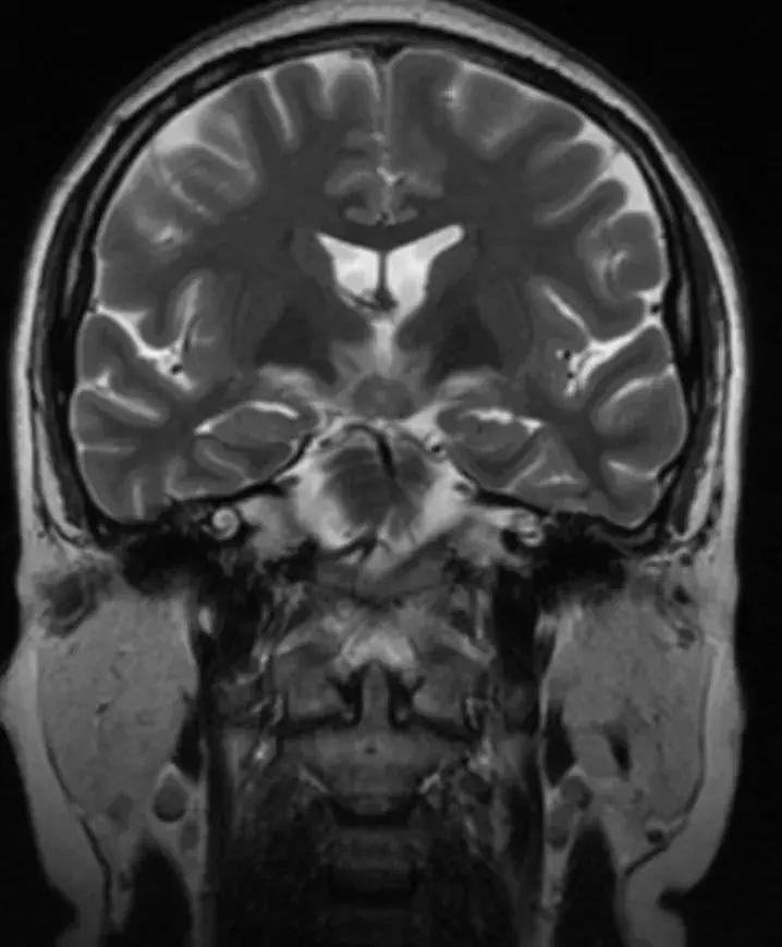 复旦大学附属中山医院放射科病例讨论（八十四）