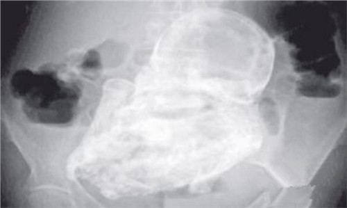 怀孕后死胎的几种症状及原因,希望每位孕妈妈和小宝贝都健健康康