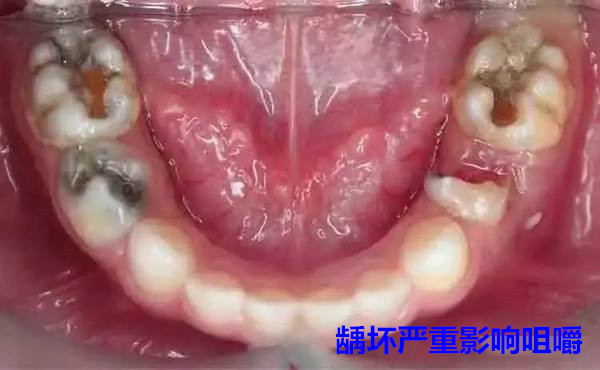 乳牙能退，所以龋坏不用补？出现这些问题，后悔都来不及