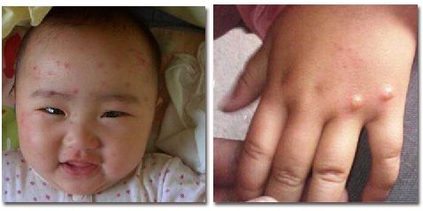 家长注意小孩感冒发烧流感,宝宝发烧咳嗽流鼻涕身上起红疹