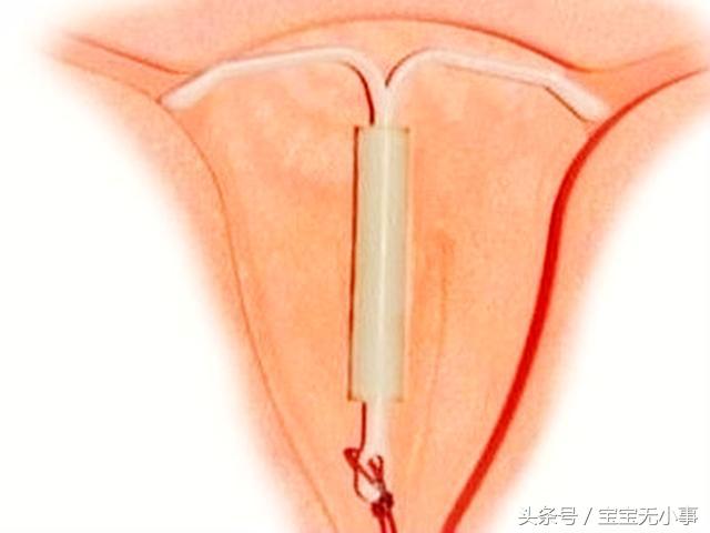 上环难受还是取环难受,取环疼还是上环痛