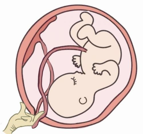 产妇突发脐带脱垂,生死时速孕妇大出血片段