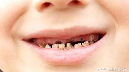 龋齿原因及防治方法,小儿龋齿的原因及防治措施