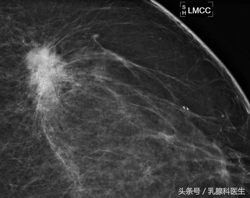 孕期发现腋下有肿块怎么办,乳腺肿物3类是怎么回事