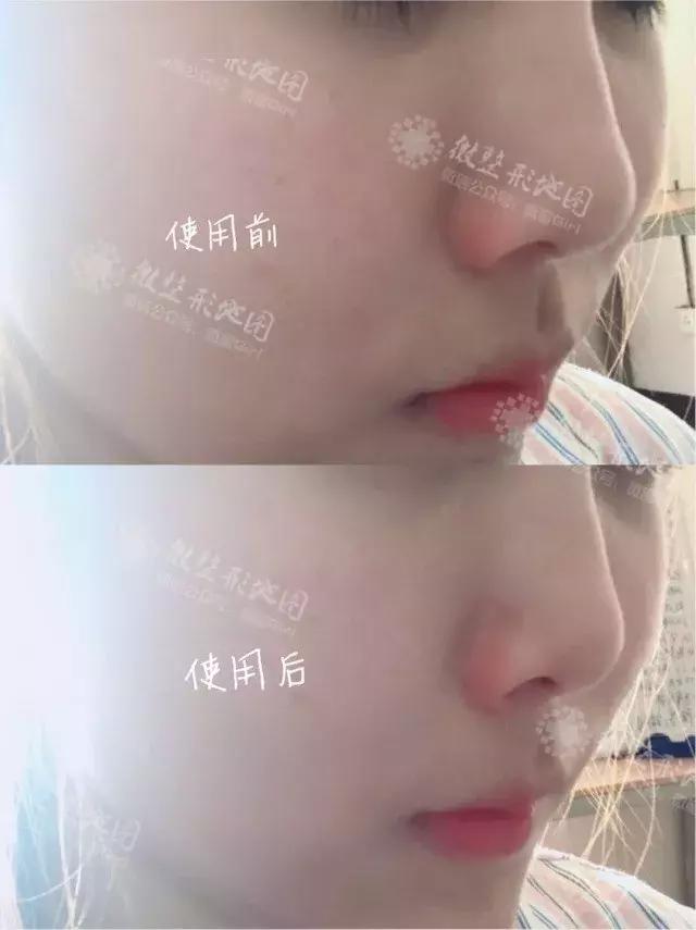 整形“神器”大测评：传说中的隆鼻夹真的靠谱吗？