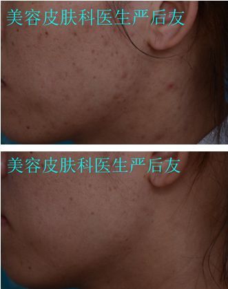 皮肤科医生是怎么祛痘祛痘坑的,皮肤科专家美容祛斑方法