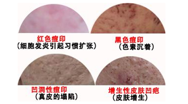 快速祛痘印小窍门真的管用,教你几招祛痘印的最快方法