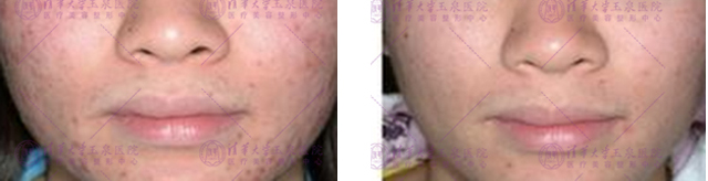 快速祛痘印小窍门真的管用,教你几招祛痘印的最快方法