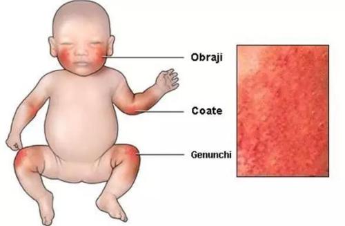 湿疹到医院医生要给做哪些检查,湿疹要看中医吗