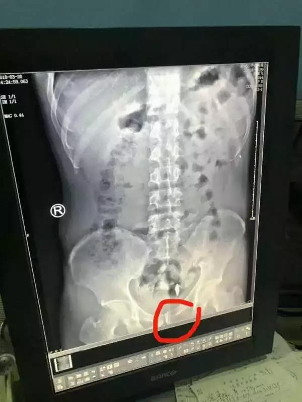 吸毒人吞刀片是怎么回事,吸毒吞食异物为什么躲避惩罚