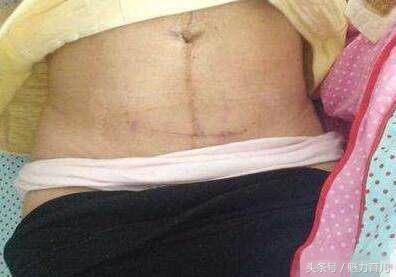 顺产和剖腹产哪个更痛,顺产侧切有多疼