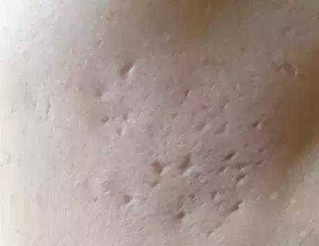 错误的祛痘印方法,错误的祛皱方法