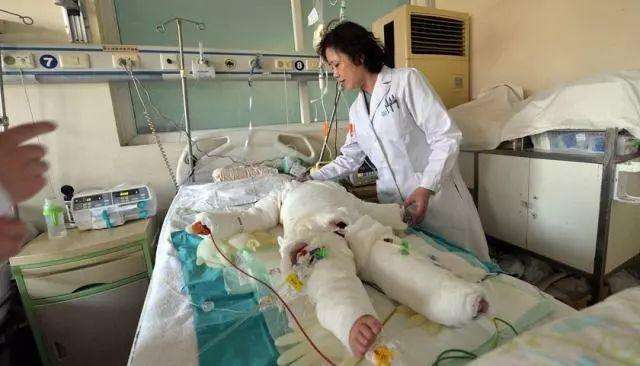 烧水烫伤紧急处理,烫伤烧伤的紧急处理ppt