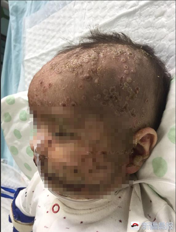 3岁水痘护理,三个月宝宝感染水痘会很严重吗