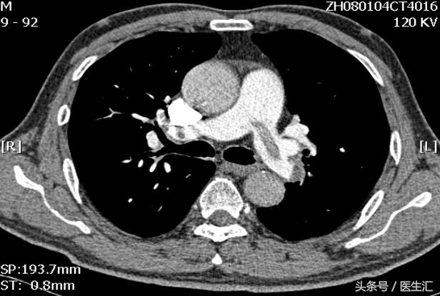 肺血栓栓塞溶栓治疗药物,肺血栓栓塞溶栓手法