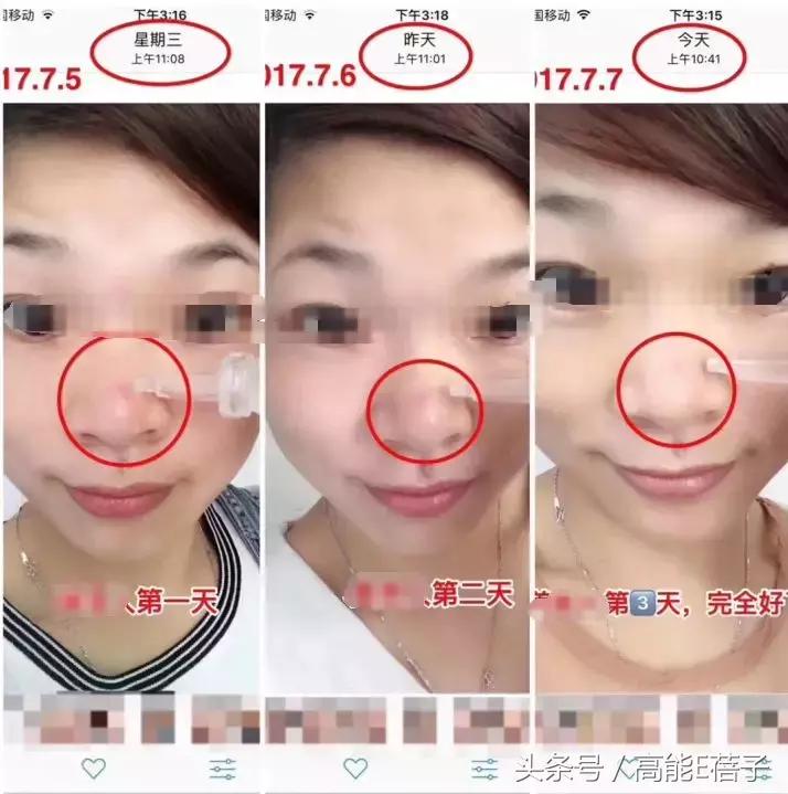 别傻了！蔡徐坤、Angelababy都根治不掉的黑头，微商神器能去除？