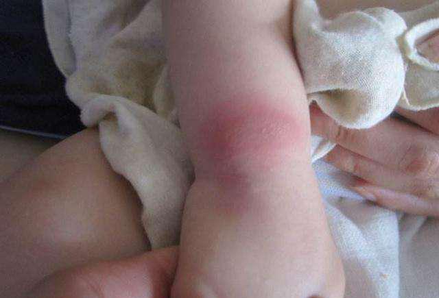 孩子被蚊子叮出大泡了怎么办,小孩被蚊子叮了大包