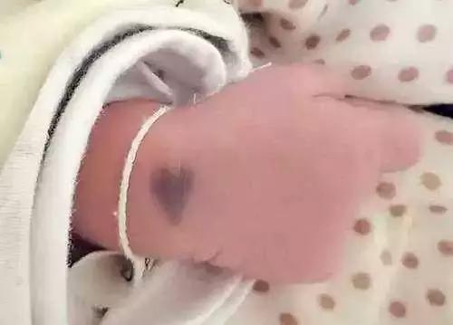 宝宝小屁屁发红怎么办,宝宝小屁屁突然红肿