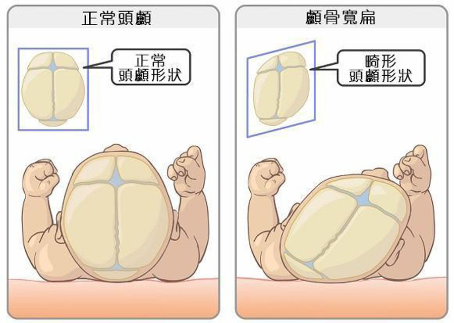 四个月宝宝偏头怎么纠正,十个月的宝宝睡偏头怎么办