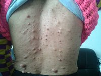 身上长了一个凸起来的肉坨,身上长小肉坨是什么原因