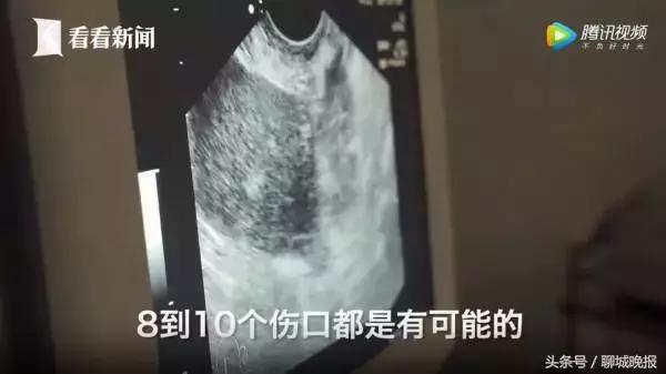 18岁姑娘多次捐卵致生命垂危,女学生捐卵新闻