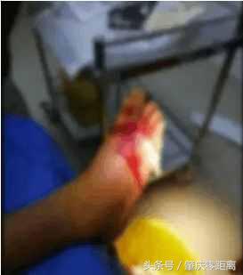 男子被毒蛇咬伤视频,有人被毒蛇咬伤现场应该如何处理