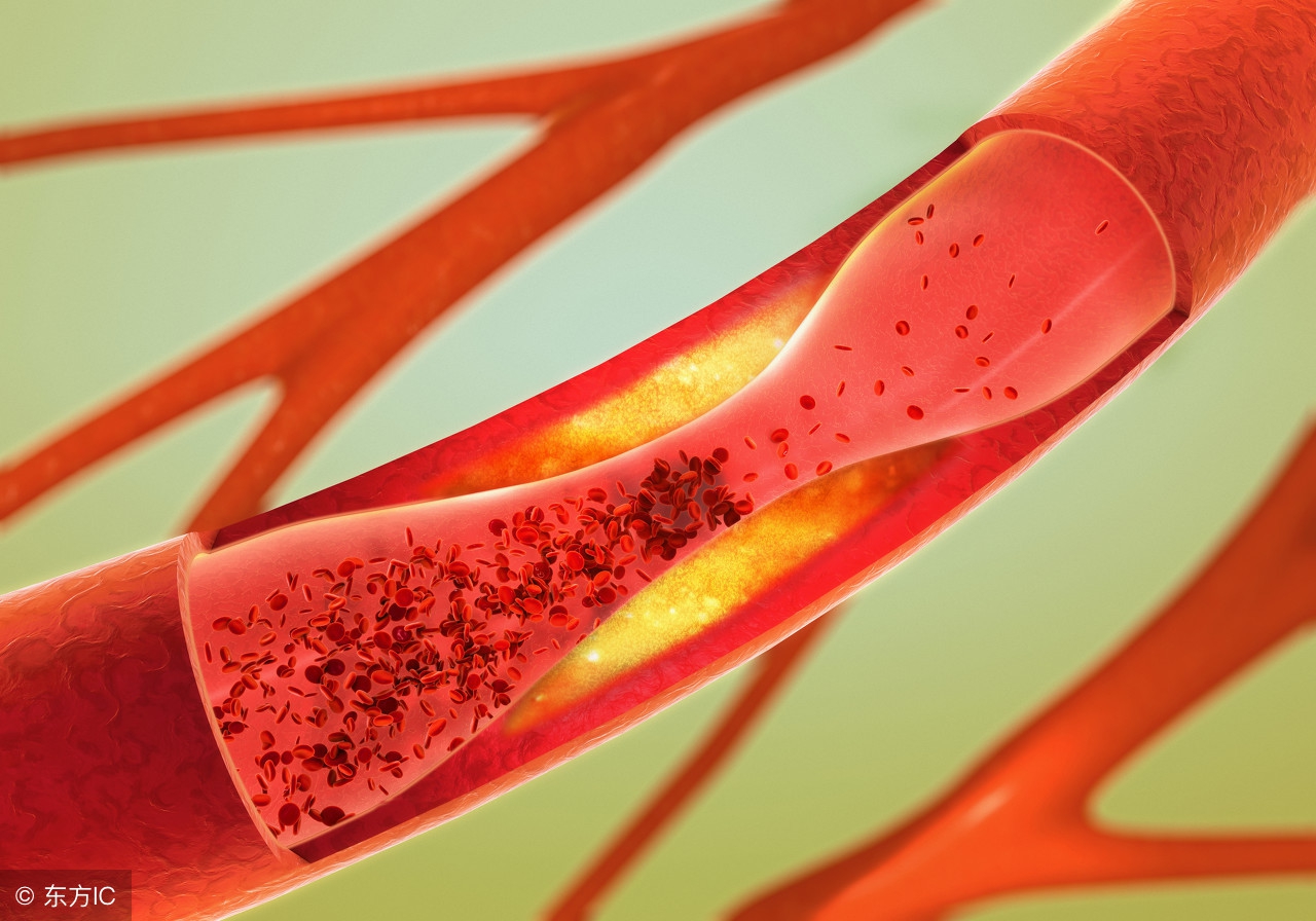 动脉粥样硬化能长期服用氯吡格雷,动脉粥样硬化单吃氯吡格雷可以吗