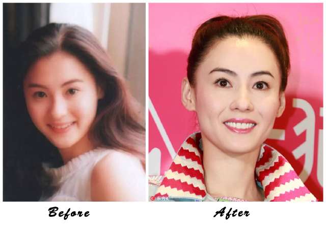 阿娇整牙,阿娇整牙前后对比