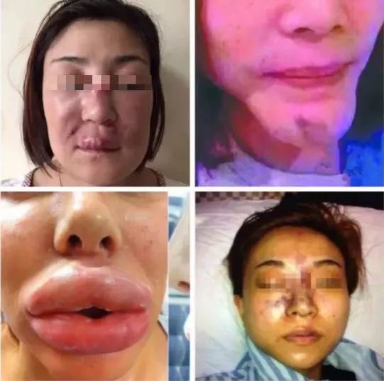 90%的人都不了解的玻尿酸真相,关于玻尿酸这些知识要知道