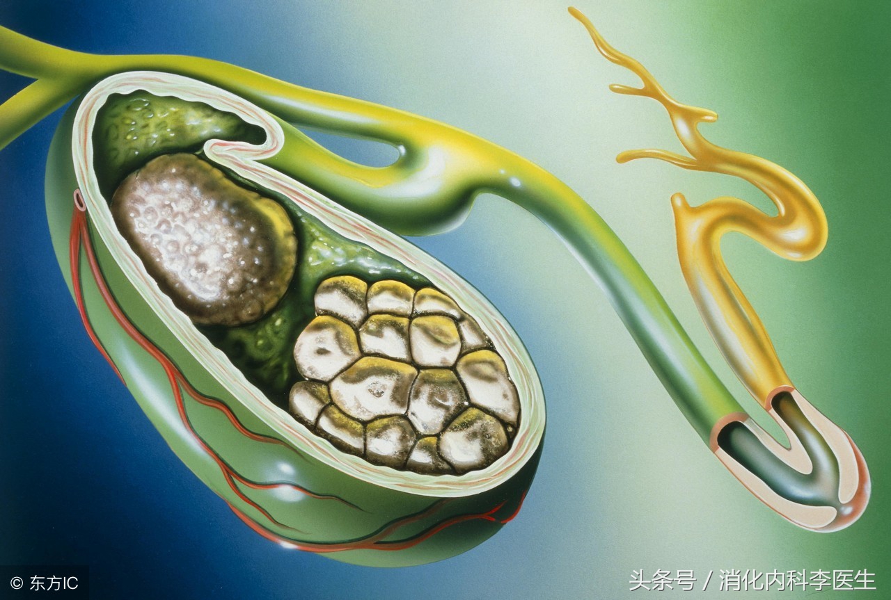 胆结石在消化内科怎么治疗,胆结石挂消化内科还是肝胆外科