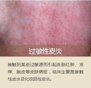 面部脂溢性皮炎是艾滋病吗,面部脂溢性皮炎刺痛怎么办